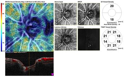 Optical coherence tomography angiography findings in patients affected by giant cell arteritis, with and without ocular involvement: a pilot study